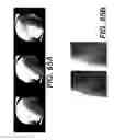 Fig. 45 - Surgical navigation of the hip using fluoroscopy and tracking sensors