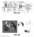 Fig. 48 - Surgical navigation of the hip using fluoroscopy and tracking sensors