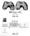 Fig. 53 - Surgical navigation of the hip using fluoroscopy and tracking sensors