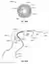 Fig. 167 - Vapor based ablation system for treating uterine bleeding