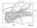 Fig. 47 - Vapor based ablation system for treating uterine bleeding