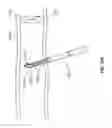 Fig. 52 - Vapor based ablation system for treating uterine bleeding