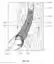 Fig. 76 - Vapor based ablation system for treating uterine bleeding