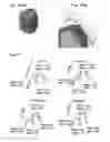 Fig. 17 - Partial dental arch and method for manufacturing a partial arch