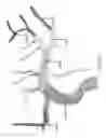 Fig. 14 - Systems for aspirating thrombus during neurosurgical procedures