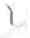 Fig. 216 - Systems for aspirating thrombus during neurosurgical procedures