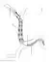 Fig. 221 - Systems for aspirating thrombus during neurosurgical procedures
