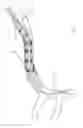 Fig. 232 - Systems for aspirating thrombus during neurosurgical procedures