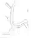 Fig. 237 - Systems for aspirating thrombus during neurosurgical procedures