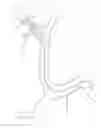 Fig. 239 - Systems for aspirating thrombus during neurosurgical procedures