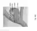 Fig. 255 - Systems for aspirating thrombus during neurosurgical procedures