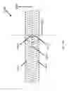 Fig. 31 - Systems for aspirating thrombus during neurosurgical procedures