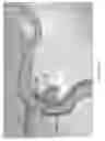 Fig. 62 - Systems for aspirating thrombus during neurosurgical procedures