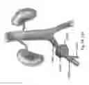 Fig. 63 - Systems for aspirating thrombus during neurosurgical procedures