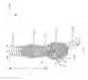 Fig. 70 - Systems for aspirating thrombus during neurosurgical procedures