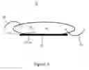 Fig. 04 - Exocapsular device and method for lens stabilization