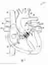 Fig. 02 - Methods and devices for delivery of a prosthetic valve