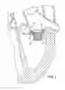 Fig. 06 - Method of replacing mitral valve