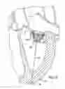 Fig. 07 - Method of replacing mitral valve