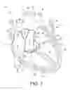 Fig. 02 - Segmented, growth-accommodating, artificial valve
