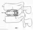 Fig. 02 - Expandable fusion device and method of installation thereof