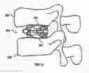 Fig. 10 - Expandable fusion device and method of installation thereof