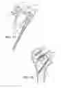 Fig. 08 - Robotic system for shoulder arthroplasty using stemless implant components
