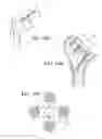 Fig. 09 - Robotic system for shoulder arthroplasty using stemless implant components