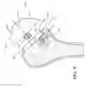 Fig. 06 - Robotic system for shoulder arthroplasty using stemless implant components