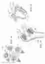 Fig. 07 - Robotic system for shoulder arthroplasty using stemless implant components