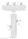 Fig. 02 - METHODS FOR PLACING A STENT IN A BRANCHED VESSEL