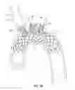 Fig. 26 - METHODS FOR PLACING A STENT IN A BRANCHED VESSEL
