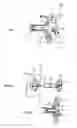 Fig. 02 - Ostomy appliance