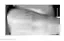 Fig. 34 - Compositions and methods for the treatment of skin lesions