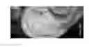 Fig. 40 - Compositions and methods for the treatment of skin lesions
