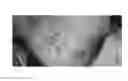 Fig. 57 - Compositions and methods for the treatment of skin lesions