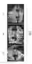 Fig. 06 - Phosphocalcic cement composition comprising blood