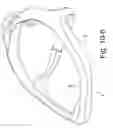 Fig. 33 - Delivery of respiratory therapy using collapsible inlet conduits