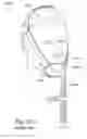 Fig. 65 - Delivery of respiratory therapy using collapsible inlet conduits