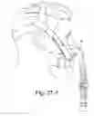 Fig. 71 - Delivery of respiratory therapy using collapsible inlet conduits
