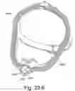Fig. 79 - Delivery of respiratory therapy using collapsible inlet conduits