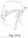 Fig. 87 - Delivery of respiratory therapy using collapsible inlet conduits