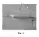 Fig. 09 - Medical device, method and system for temporary occlusion of an opening in a lumen of a body