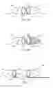 Fig. 06 - Clot removal device and method of using same