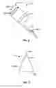 Fig. 03 - Thrombectomy catheter
