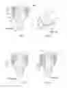 Fig. 02 - Trocar seal membrane and assembly comprising normal and reverse concave channels