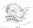 Fig. 07 - Fetus delivery assisting device