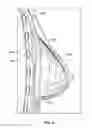 Fig. 07 - Mesh pouch for medical implant and method for using same