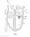 Fig. 02 - Systems and methods for percutaneously supporting and manipulating a septal wall