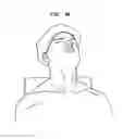 Fig. 32 - Intervertebral disc and insertion methods therefor